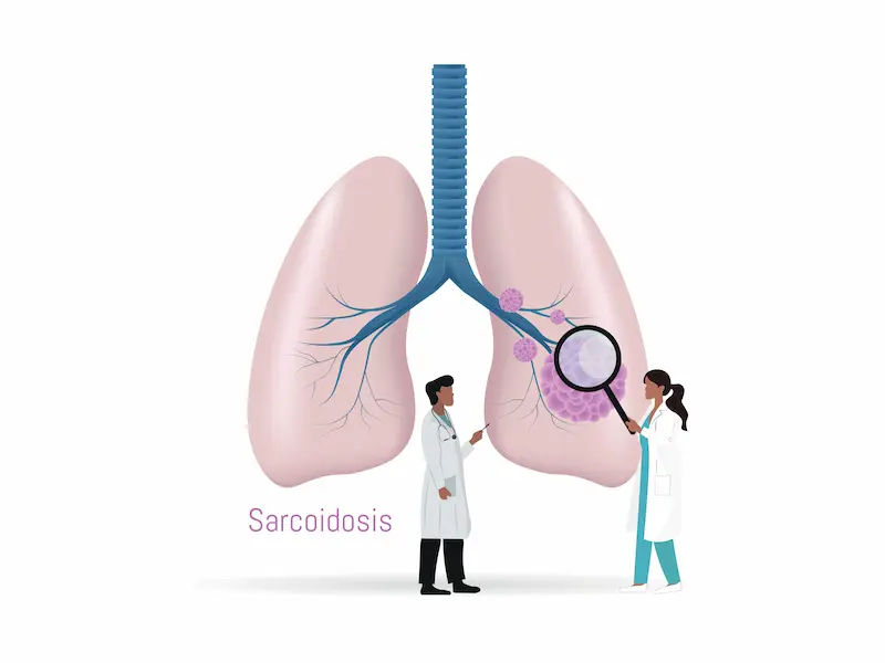 Understanding Sarcoidosis: Causes and Treatment Options